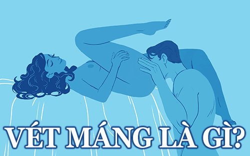 vét máng là gì?